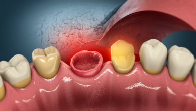 Images of Tooth Extraction Infection